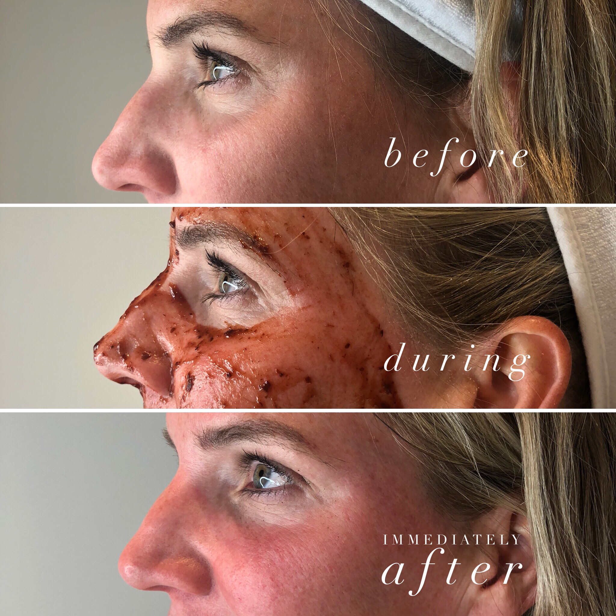 Trifecta Resurfacing Peel