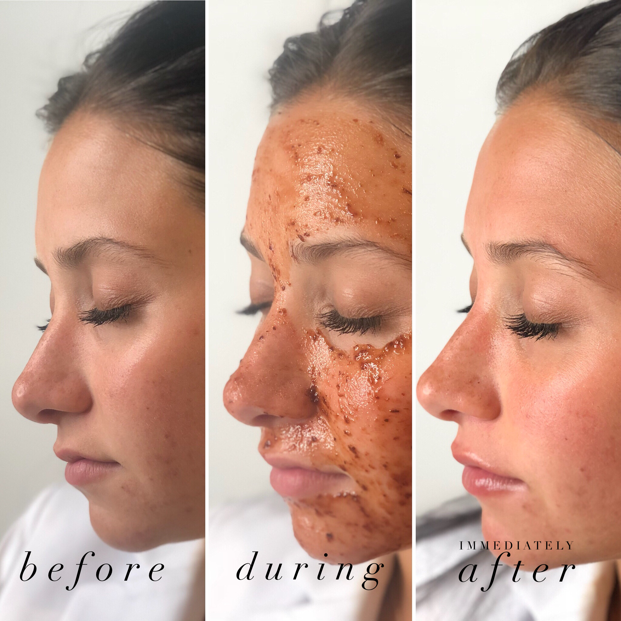Trifecta Resurfacing Peel